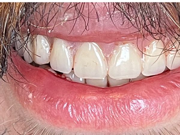 After removable dentures treatment