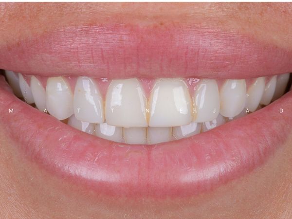 Before cosmetic dentistry treatment